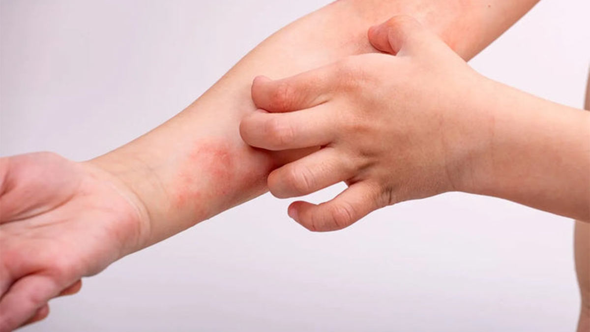 اگزما چیست و چرا درمان آن اهمیت دارد؟